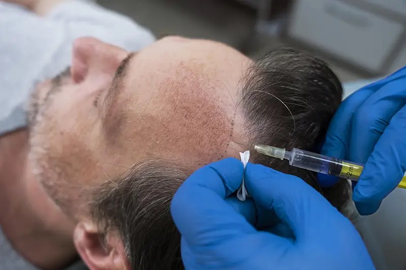 Follicular unit extraction financing