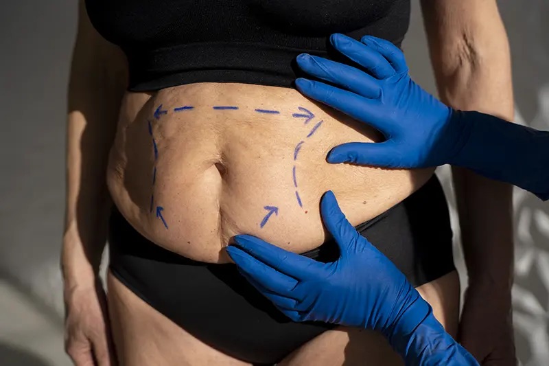 Liposculpture financing programs