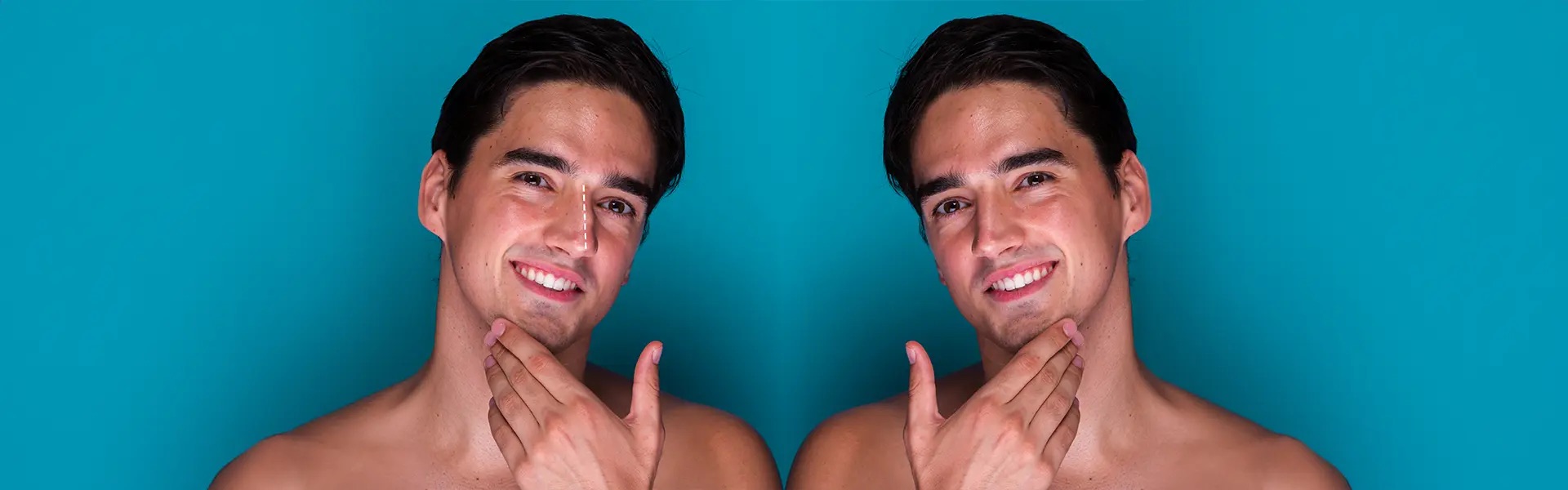 Rhinoplasty